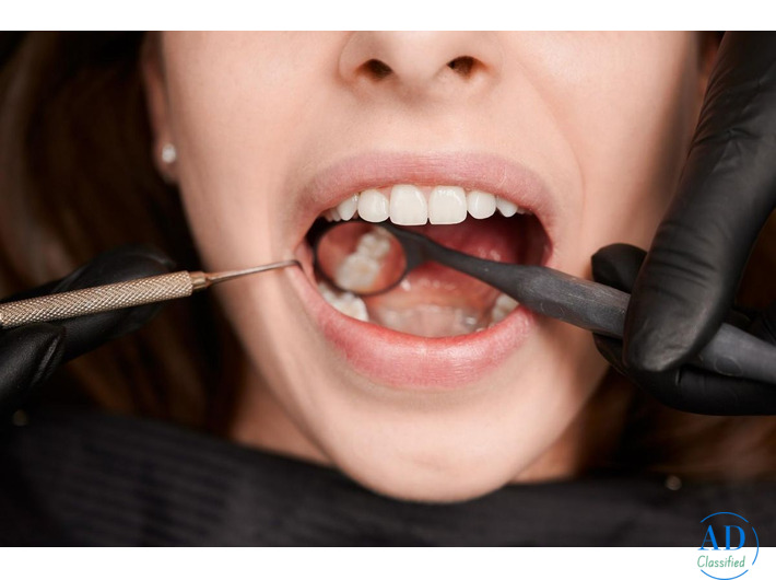 Get Tooth-Colored Fillings for a Perfect Smile in the USA