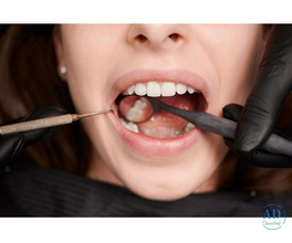 Get Tooth-Colored Fillings for a Perfect Smile in the USA