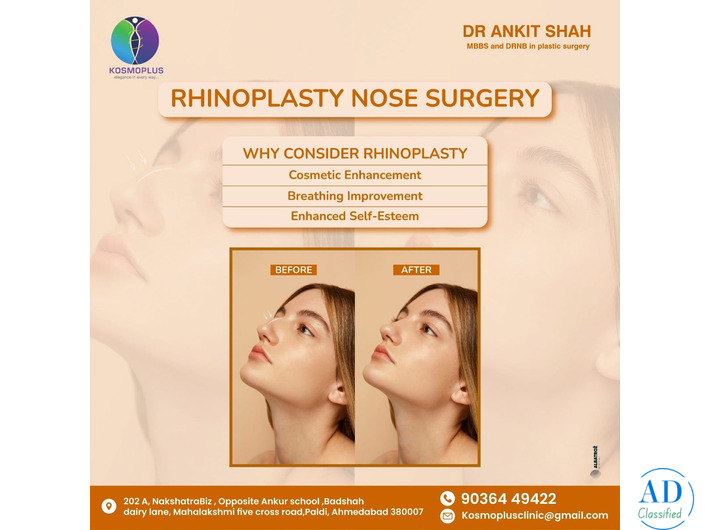 Advanced Rhinoplasty in Ahmedabad with Expert Care at Kosmoplus