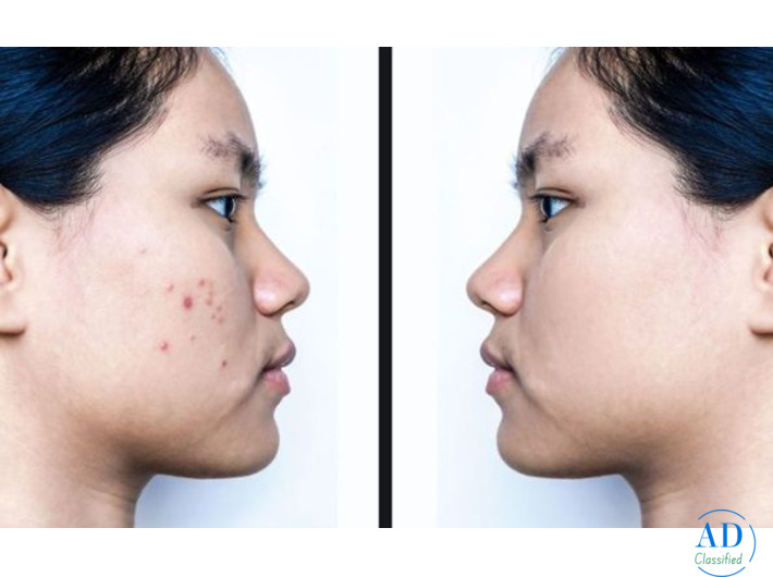 Revitalize Your Skin With Our Non-Invasive Facelift