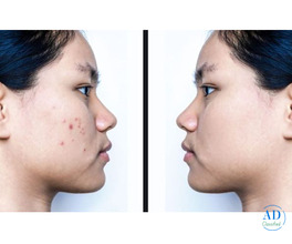 Revitalize Your Skin With Our Non-Invasive Facelift